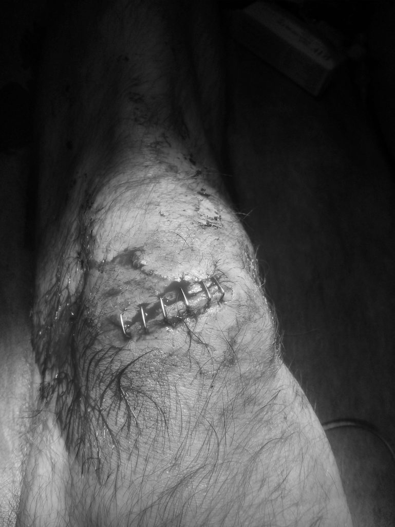 Franken-knee
